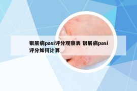 银屑病pasi评分观察表 银屑病pasi评分如何计算
