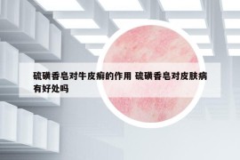 硫磺香皂对牛皮癣的作用 硫磺香皂对皮肤病有好处吗