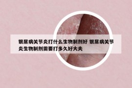 银屑病关节炎打什么生物制剂好 银屑病关节炎生物制剂需要打多久好大夫