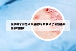 皮肤破了会感染银屑病吗 皮肤破了会感染银屑病吗图片