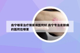 南宁哪家治疗银屑病医院好 南宁专治皮肤病的医院在哪里