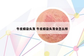 牛皮癣染头发 牛皮癣染头发会怎么样
