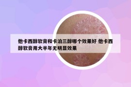 他卡西醇软膏和卡泊三醇哪个效果好 他卡西醇软膏用大半年无明显效果