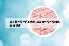后背长一片一片的像癣 后背长一片一片的像癣 还很痒