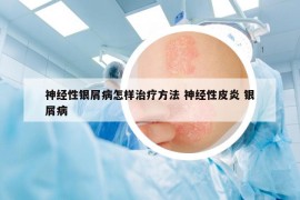 神经性银屑病怎样治疗方法 神经性皮炎 银屑病