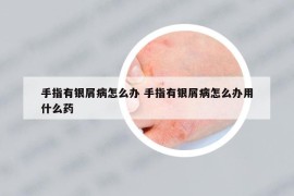 手指有银屑病怎么办 手指有银屑病怎么办用什么药