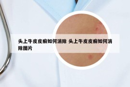 头上牛皮皮癣如何消除 头上牛皮皮癣如何消除图片