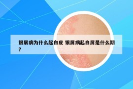银屑病为什么起白皮 银屑病起白屑是什么期?