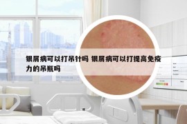 银屑病可以打吊针吗 银屑病可以打提高免疫力的吊瓶吗