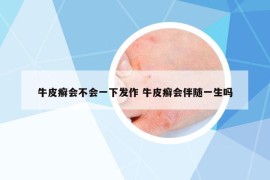 牛皮癣会不会一下发作 牛皮癣会伴随一生吗