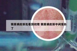 银屑病皮损处看到纹理 银屑病皮损中间变白了