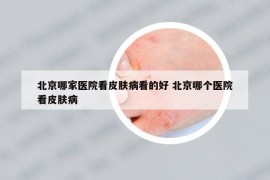 北京哪家医院看皮肤病看的好 北京哪个医院看皮肤病