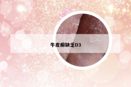 牛皮癣缺乏D3