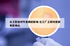 化工职业对牛皮癣的影响 化工厂上班对皮肤有影响么