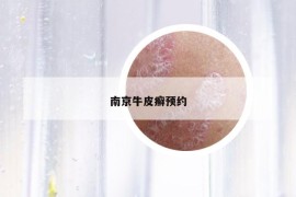 南京牛皮癣预约