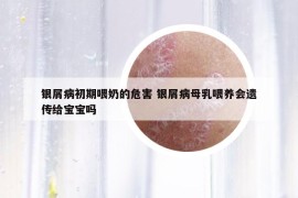 银屑病初期喂奶的危害 银屑病母乳喂养会遗传给宝宝吗