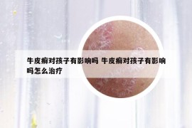 牛皮癣对孩子有影响吗 牛皮癣对孩子有影响吗怎么治疗