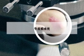 牛皮癣水光