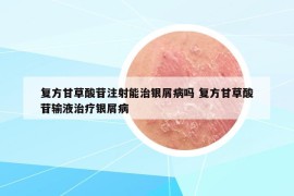 复方甘草酸苷注射能治银屑病吗 复方甘草酸苷输液治疗银屑病