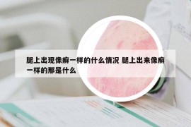 腿上出现像癣一样的什么情况 腿上出来像癣一样的那是什么