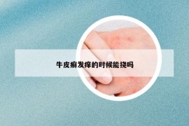 牛皮癣发痒的时候能挠吗