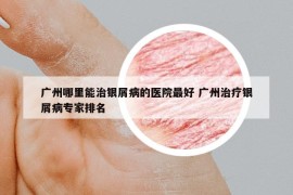 广州哪里能治银屑病的医院最好 广州治疗银屑病专家排名