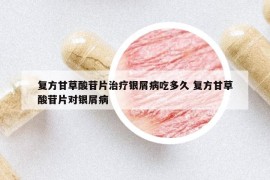 复方甘草酸苷片治疗银屑病吃多久 复方甘草酸苷片对银屑病