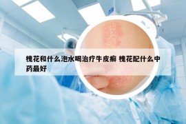 槐花和什么泡水喝治疗牛皮癣 槐花配什么中药最好