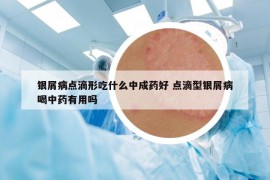 银屑病点滴形吃什么中成药好 点滴型银屑病喝中药有用吗