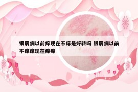 银屑病以前痒现在不痒是好转吗 银屑病以前不痒痒现在痒痒