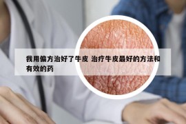 我用偏方治好了牛皮 治疗牛皮最好的方法和有效的药