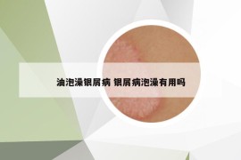 油泡澡银屑病 银屑病泡澡有用吗