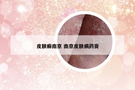 皮肤癣南京 南京皮肤病药膏