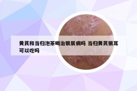 黄芪和当归泡茶喝治银屑病吗 当归黄芪银耳可以吃吗