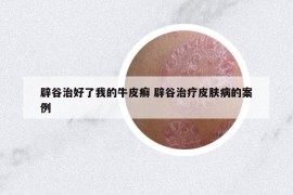 辟谷治好了我的牛皮癣 辟谷治疗皮肤病的案例