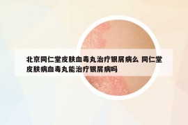 北京同仁堂皮肤血毒丸治疗银屑病么 同仁堂皮肤病血毒丸能治疗银屑病吗