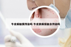 牛皮癣触摸传染吗 牛皮肤癣接触会传染吗