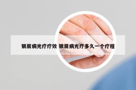 银屑病光疗疗效 银屑病光疗多久一个疗程