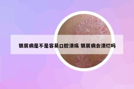 银屑病是不是容易口腔溃疡 银屑病会溃烂吗
