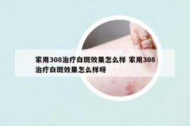 家用308治疗白斑效果怎么样 家用308治疗白斑效果怎么样呀