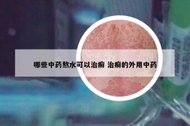 哪些中药熬水可以治癣 治癣的外用中药