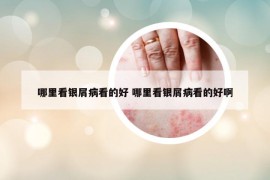 哪里看银屑病看的好 哪里看银屑病看的好啊
