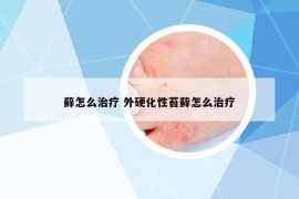 藓怎么治疗 外硬化性苔藓怎么治疗