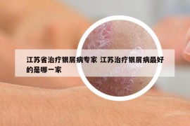 江苏省治疗银屑病专家 江苏治疗银屑病最好的是哪一家