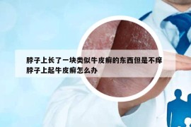 脖子上长了一块类似牛皮癣的东西但是不痒 脖子上起牛皮癣怎么办