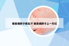 银屑病脖子痒出汗 银屑病脖子上一片红