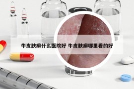 牛皮肤癣什么医院好 牛皮肤癣哪里看的好