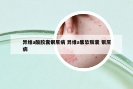 异维a酸胶囊银屑病 异维a酸软胶囊 银屑病