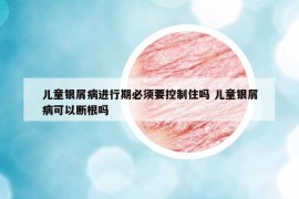儿童银屑病进行期必须要控制住吗 儿童银屑病可以断根吗