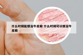 什么时候能根治牛皮癣 什么时候可以根治牛皮癣